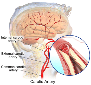 pressure on carotid artery