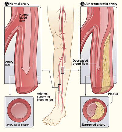 The Connection Between PAD and Poor Scar Healing