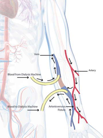 Vascular Access Creating And Protecting Dialysis Patients Lifelines Columbia University Department Of Surgery