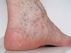 Spider veins, Symptoms & Causes