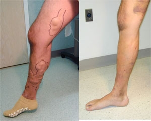 Treatment for Spider Veins & Varicose Veins - Holy Cross Medical