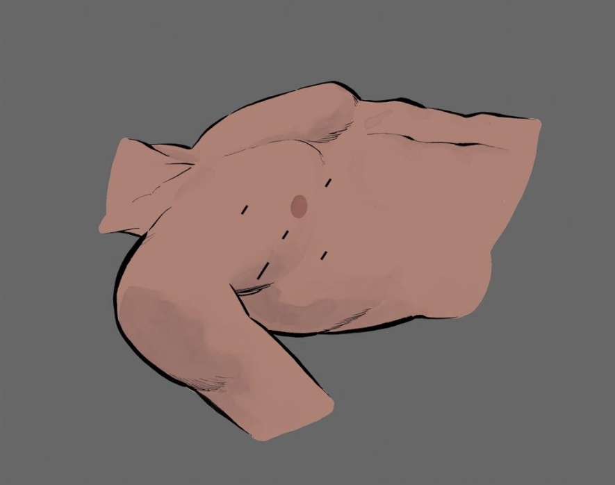 illustration showing the incision points for robotic heart surgery