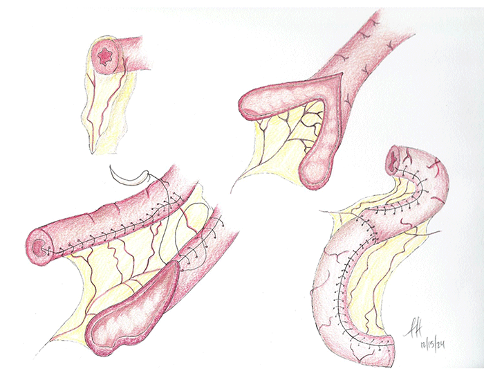 Bianchi procedure