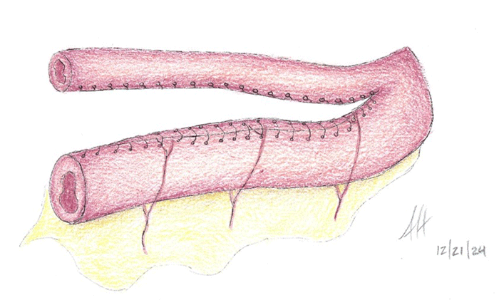 Bowel tapering