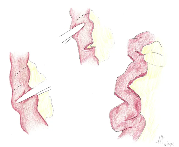 Serial Transverse Enteroplasty