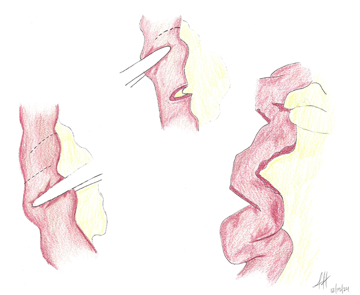 Serial Transverse Enteroplasty