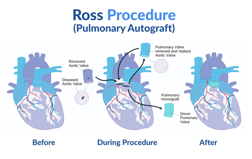 Illustration of the Ross Procedure for Aortic Valve Repair