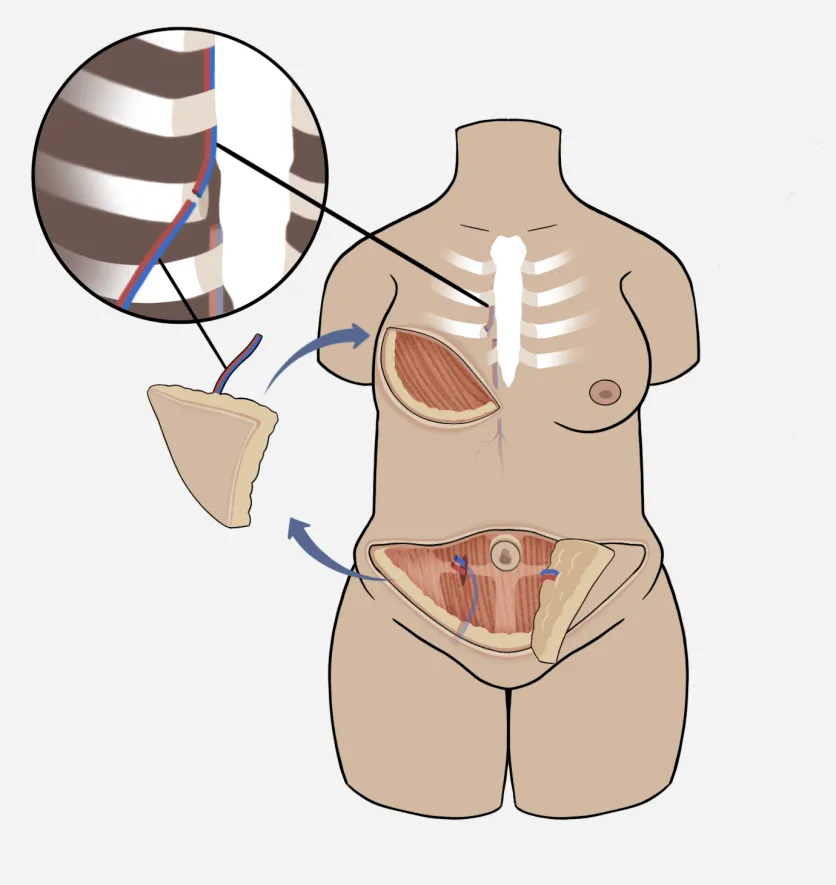 diagram of the DIEP flap procedure, showing removal of flap from abdomen and transfer to chest. Image also includes an inset close-up of the chest vasculature attaching to the new flap.