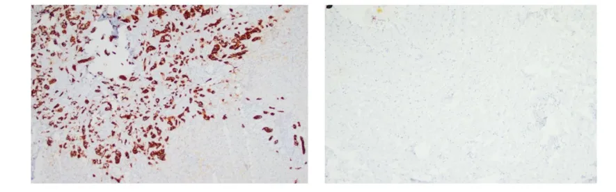 cell structures pancreatic cancer