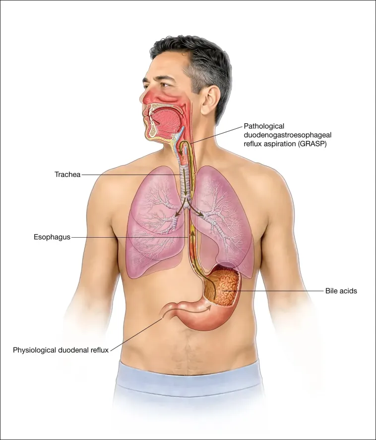anatomical model of reflux aspiration