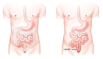Two images of the human torso, one depicting the small intestine with the large intestine greyed out (removed) and the other showing only the small intestine with the J-pouch located at its end point.