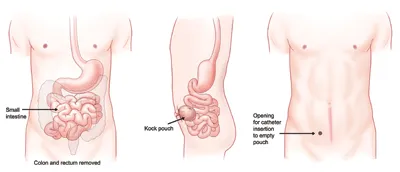 Three images of the human torso: One depicting the small intestine with the large intestine greyed out (removed); another showing only the small intestine with the K-pouch located at its end point; and a third showing just the opening for catheter insertion to empty the pouch.