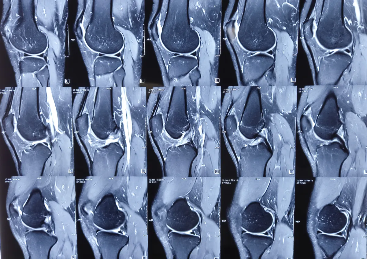 MRI of knee, bone scan