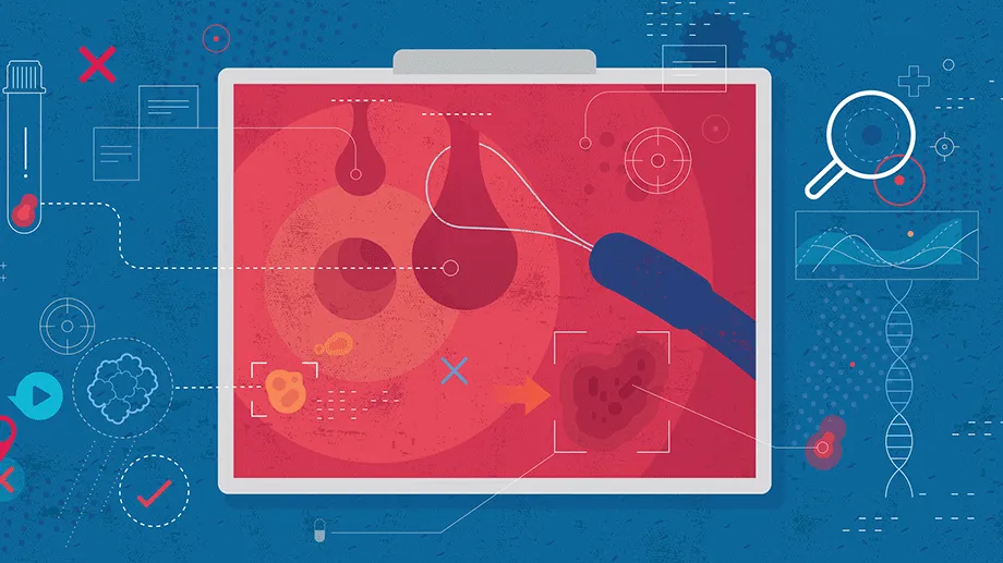 Flat vector illustration with hand drawn textures depicting the concept of colonoscopy with particular emphasis on colon polyp removal.