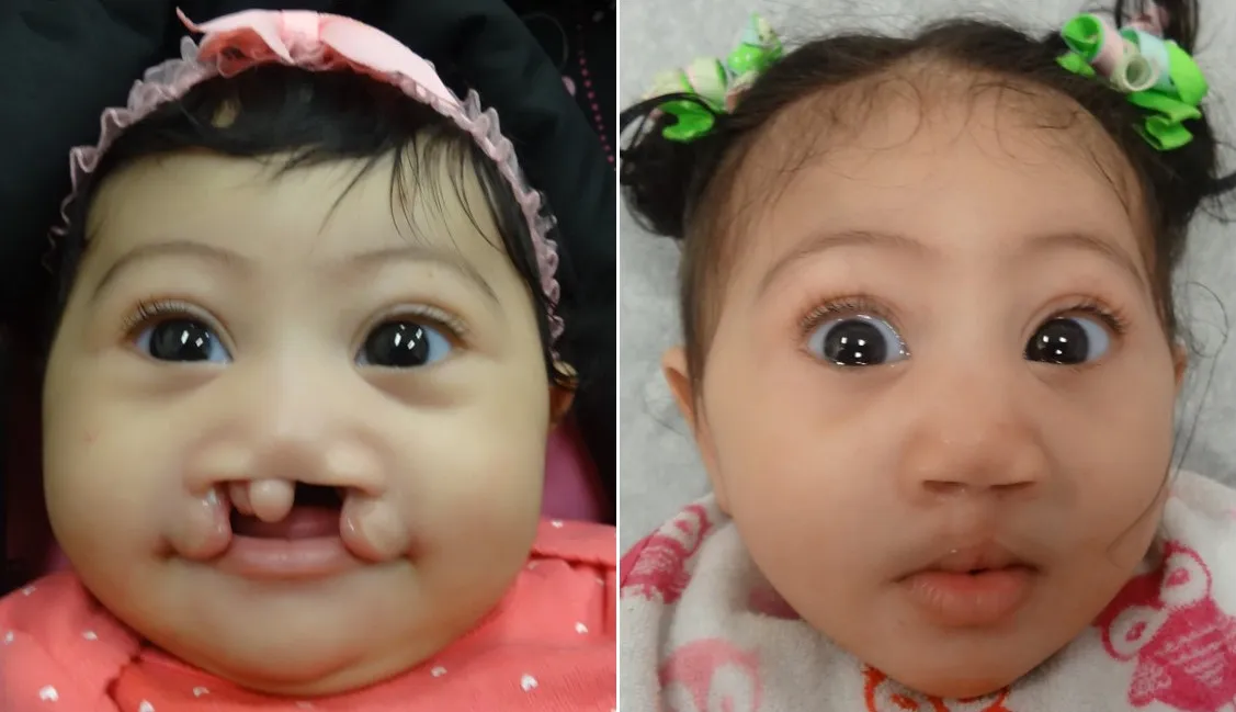 Cleft Palate/Cleft Lip Care image