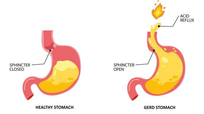 Healthy vs Gerd Stomach
