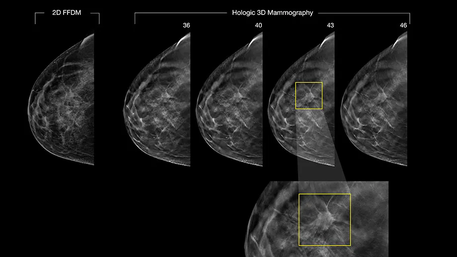 a sequence of 3D breast imaging 