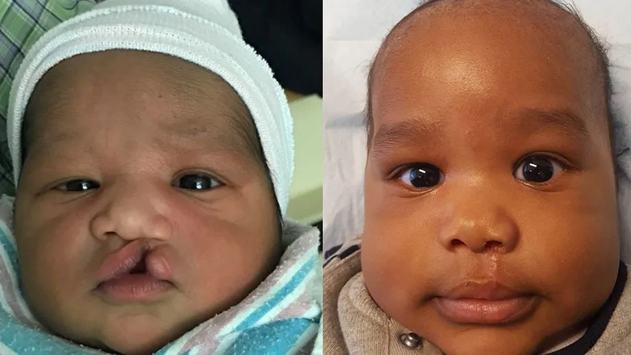 Side by side of a baby before and after cleft lip and palate surgery