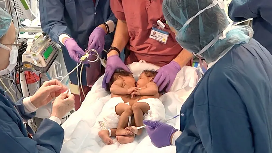 Banner: From NYP’s Health Matters: Inside the Successful Separation Surgery of Conjoined Twins