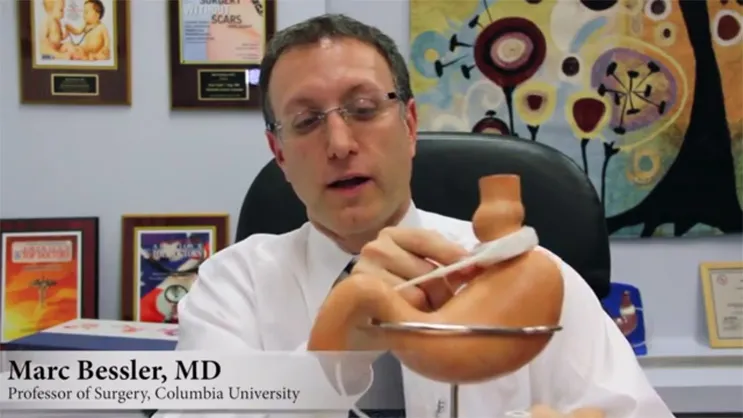 Video Thumbnail: Adjustable Gastric Banding