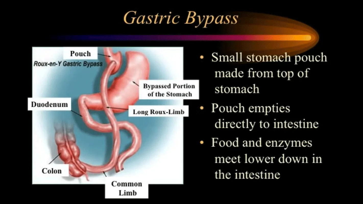 Video Thumbnail: Introduction to Bariatric Surgery