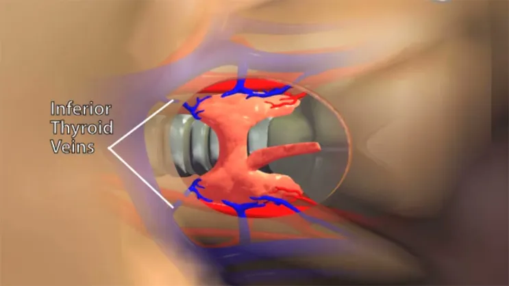 Video Thumbnail: Surgery for Thyroid Disease: Minimally Invasive Thyroid Lobectomy