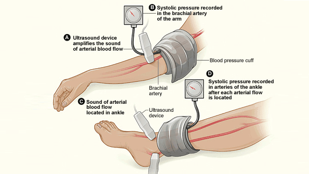 Most Common Peripheral Vascular Disease