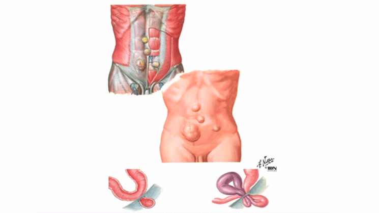 Video Thumbnail: Abdominal Wall Hernias